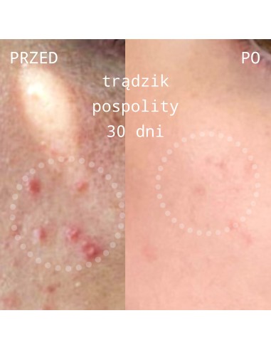 Acne Care Cream-krem przeciwtrądzikowy