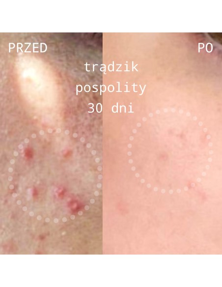 Acne Care Cream-krem przeciwtrądzikowy